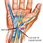 Kéz ujjperc nyílt lágyrész sérülések - Gyógyhírek