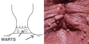 A condyloma jelei férfiaknál - Vírusos szemölcs tünetei és kezelése - HáziPatika
