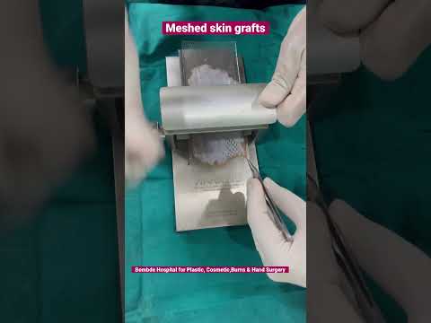 Tips:Meshed Skin grafting technique for skin graft expansion to save donor area in huge wounds cover